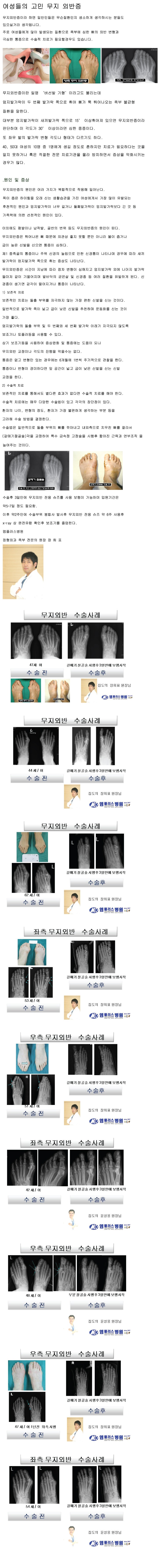 칼럼_무지외반증.jpg
