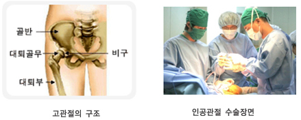 인공관절센터