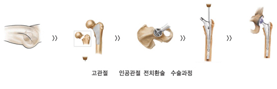 인공관절센터